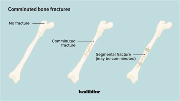 Are comminuted fracture considered displaced?