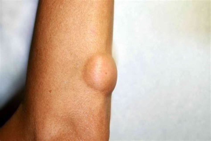 Are liposarcomas hard or soft?