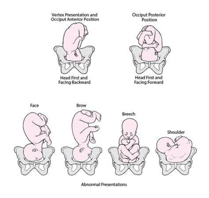 Can cephalic position change?