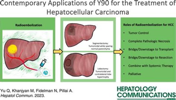How does hepatocellular carcinoma spread?
