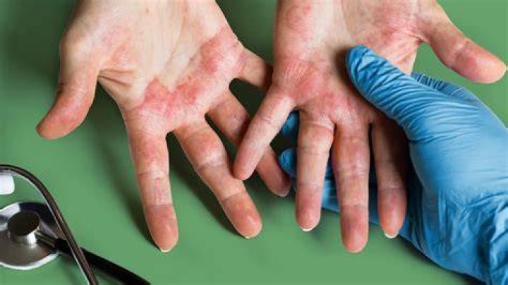 Is scrotal eczema curable?