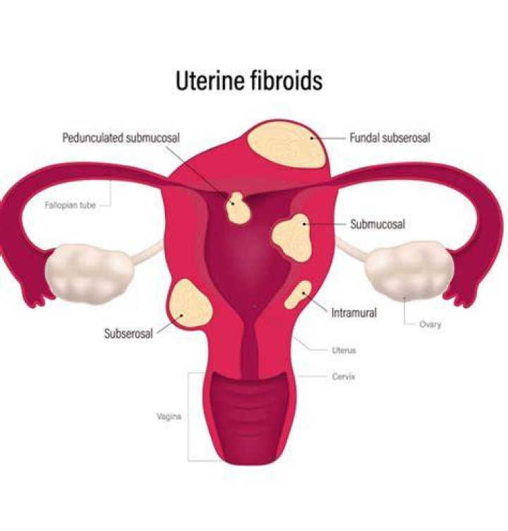 Should fibroids be treated?
