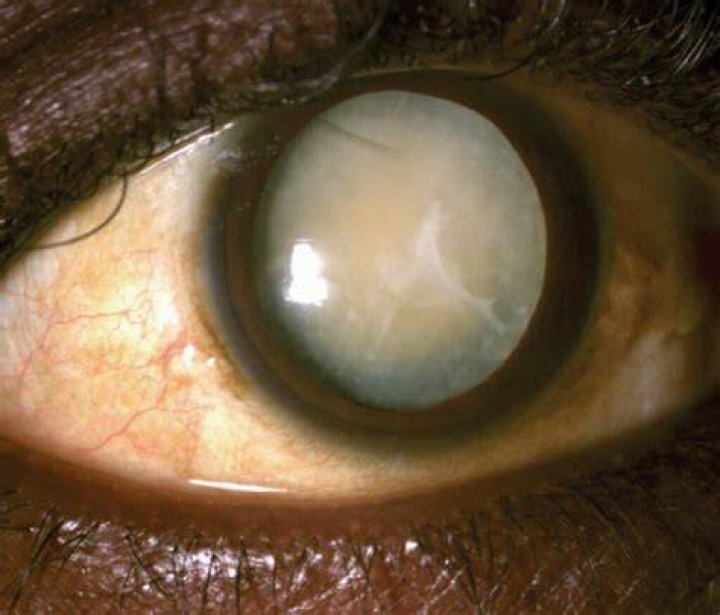 What is intumescent cataract?