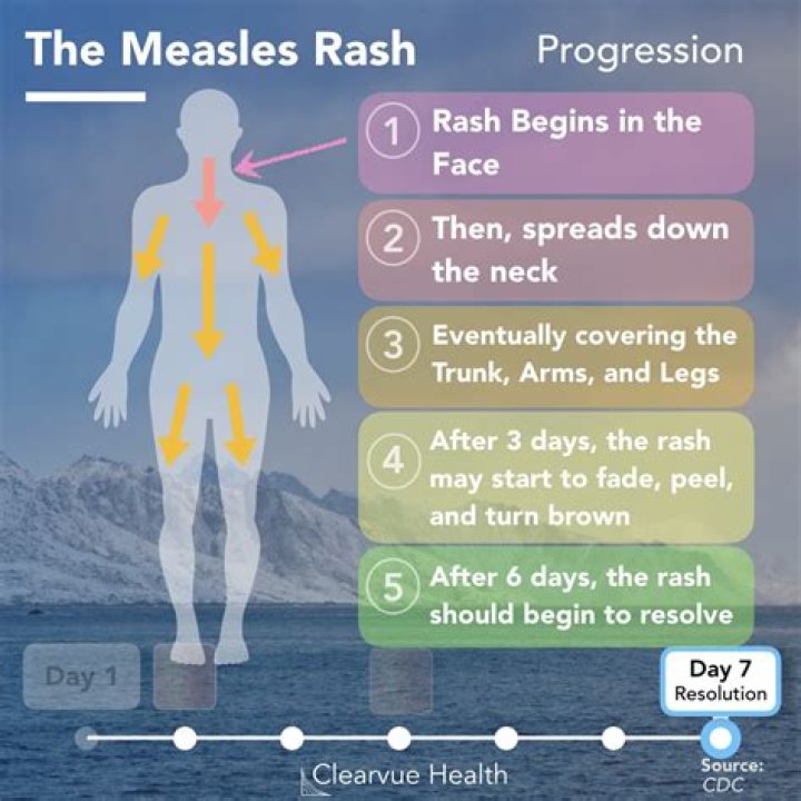 Where does the measles rash usually start?
